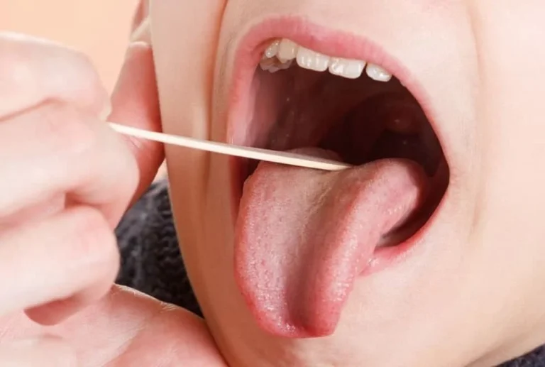 سرطان دهان و هر آنچه درباره آن باید بدانید