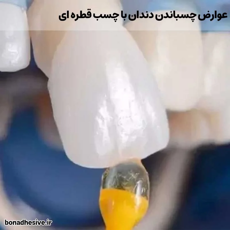 عوارض چسباندن دندان با چسب قطره ای | یک بررسی فنی و مهندسی