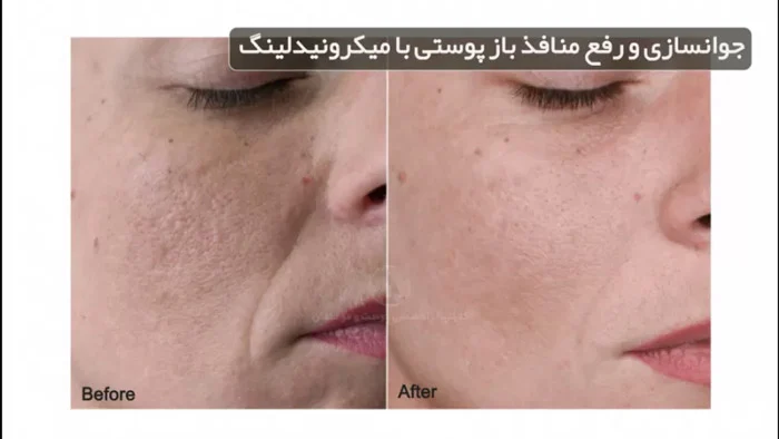 بستن منافذ باز پوست با میکرونیدلینگ